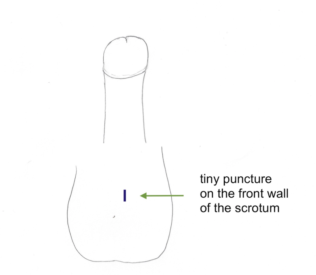 scrotum drawing showing the tiny vasectomy puncture